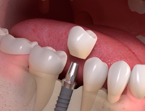 Best Smile Turkey - Dental implants