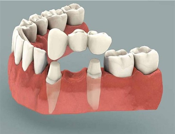 Best Smile Turkey - Dental fixtures