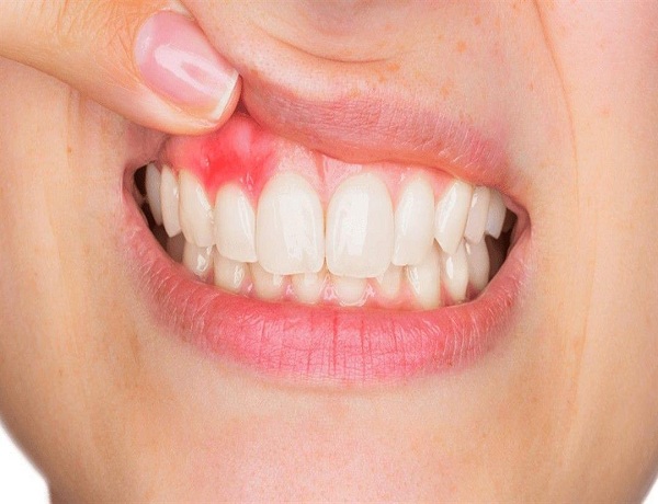 Best Smile Turkey - Treat gingivitis